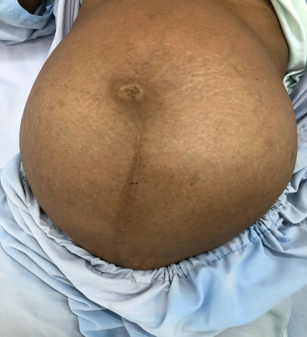 Trung tâm Y tế Tịnh Biên đã phẫu thuật thành công ca U nang buồng trứng nặng 9kg